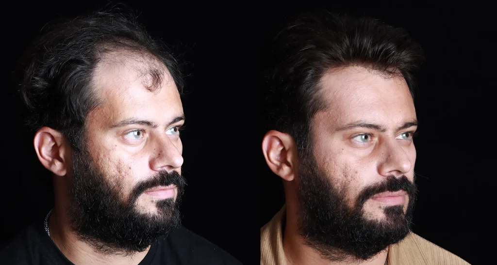 کاشت مو با تراکم بالا