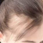 ارتباط ریزش مو و کبد چرب