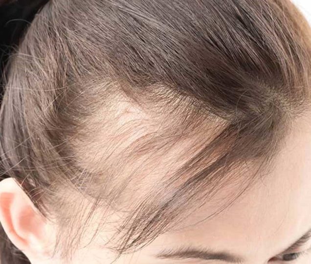 ارتباط ریزش مو و کبد چرب