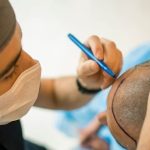 کاشت مو برای افراد با رژیم کتوژنیک