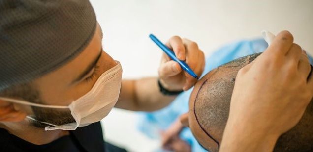 کاشت مو برای افراد با رژیم کتوژنیک