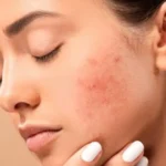 جوش زدن بعد از لیزر فراکشنال