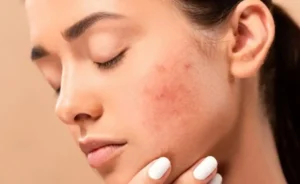 جوش زدن بعد از لیزر فراکشنال