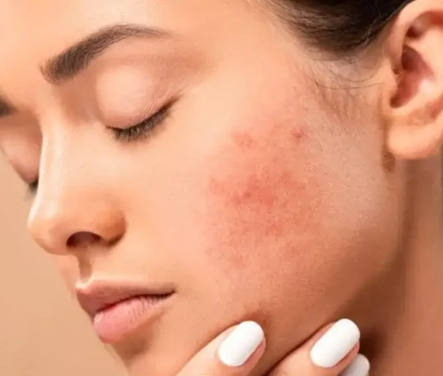 جوش زدن بعد از لیزر فراکشنال