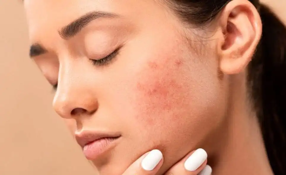 جوش زدن بعد از لیزر فراکشنال؟ علل اصلی و روش های جلوگیری