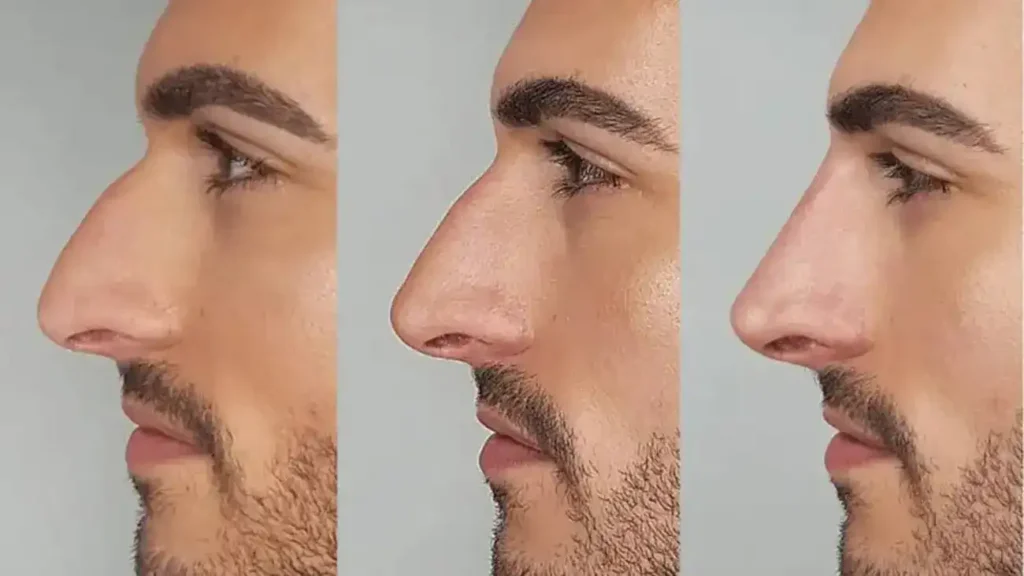 جراحی بینی با فیلر