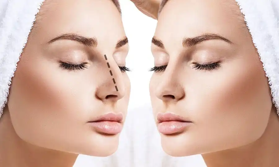 جراحی بینی با فیلر