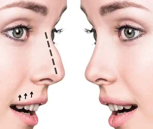 جراحی بینی با فیلر