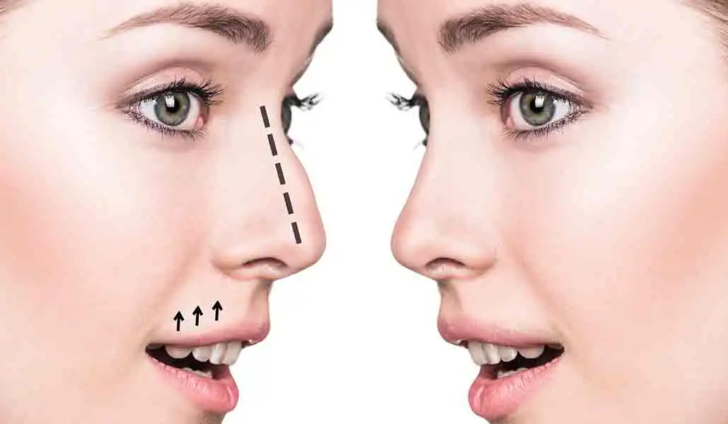 جراحی بینی با فیلر چیست؟ معرفی بهترین دکتر در تهران