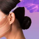 لیفت با نخ یا هایفوتراپی، کدام روش بهتر است؟