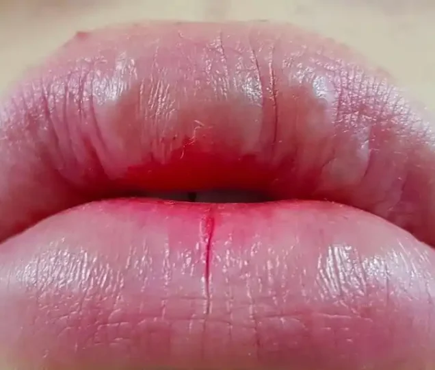 گلوله شدن ژل لب بعد از تزریق