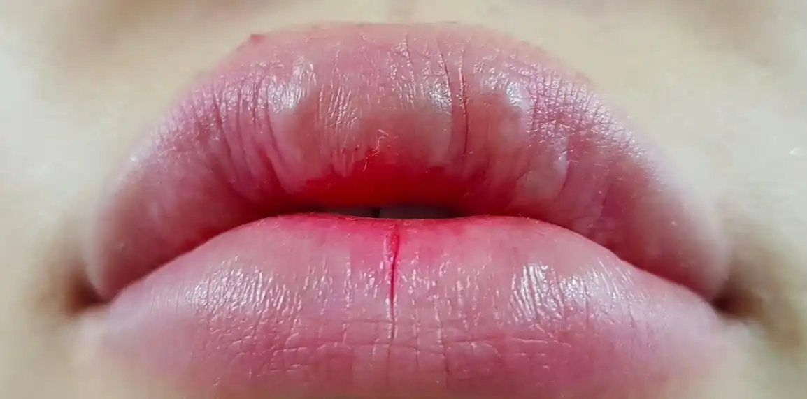 گلوله شدن ژل لب، علل + روش های جلوگیری