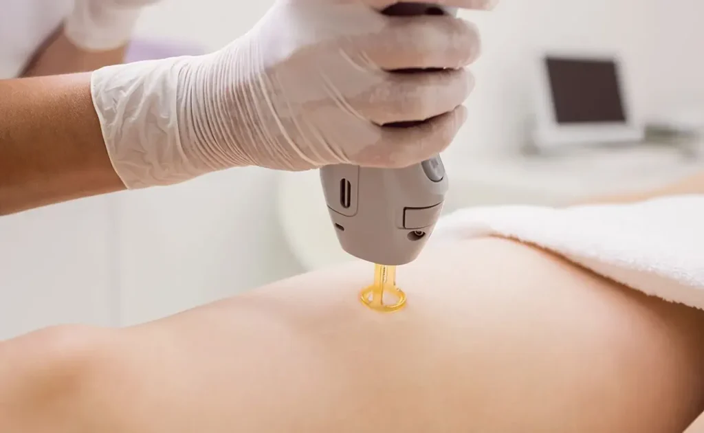 کدام مرکز در تهران لیزر کندلا اصل دارد؟